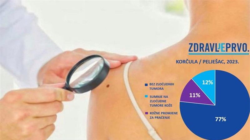Beroš: Više od 10 posto sumnji na malignu bolest kože na Korčuli i Pelješcu razlog više za preventivne preglede